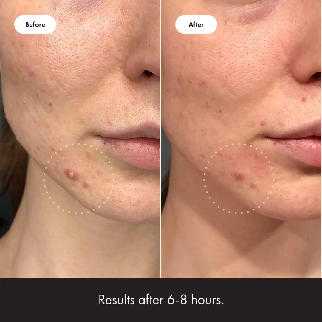 Invisible Acne Solution Patches